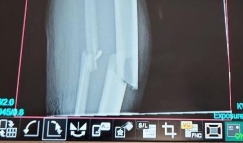 X-ray of junior Sergej Miladinovics leg shows compound break of the fibula and tibia. 