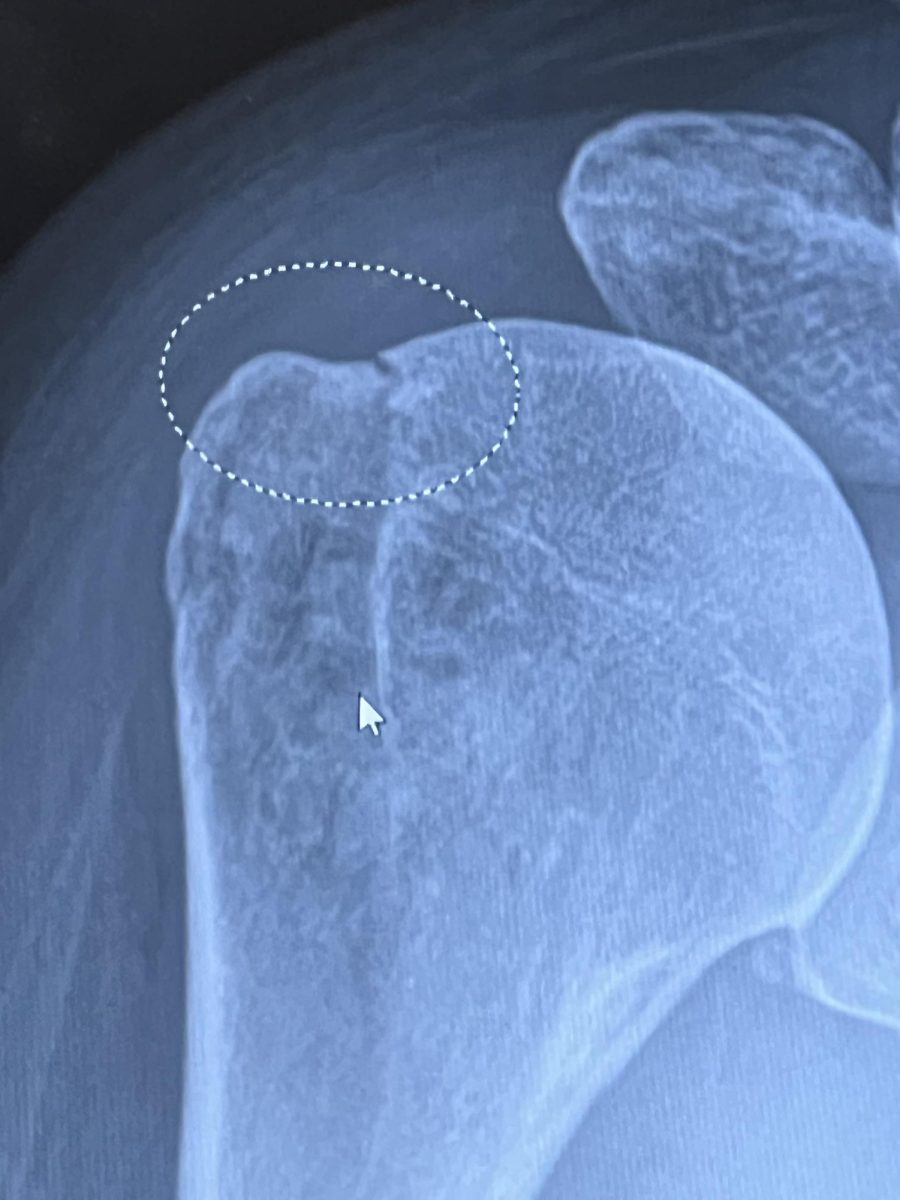 FACS teacher Missy Daubner’s shoulder injury - the circled part is where her shoulder fractured. “I'm working on range of motion in physical therapy,” Daubner said. “I’m not supposed to lift or push or pull. They want me to have my range of motion back before they start adding weight.“